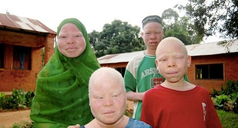 https://bliskoserca.pl/aktualnosci/pomoz-dzieciom-albinosom-w-tanzanii,2419